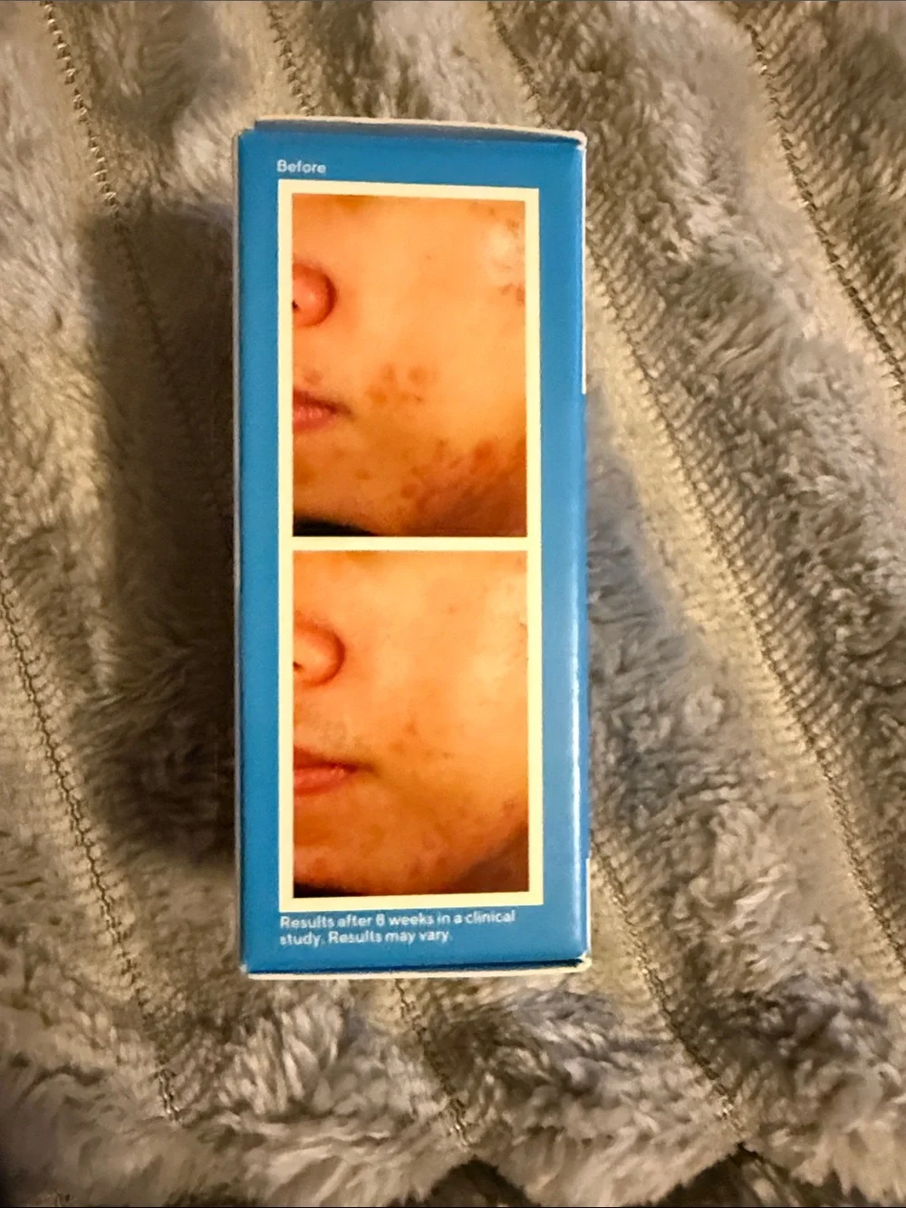 Murad Acne Control Deep Relief Acne Treatment - Blue and White